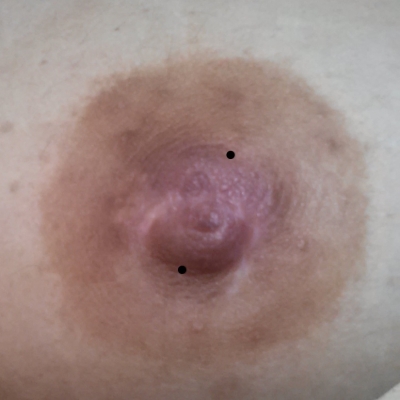 Post surgical Nipple Piercing Elayne Angel s Piercing